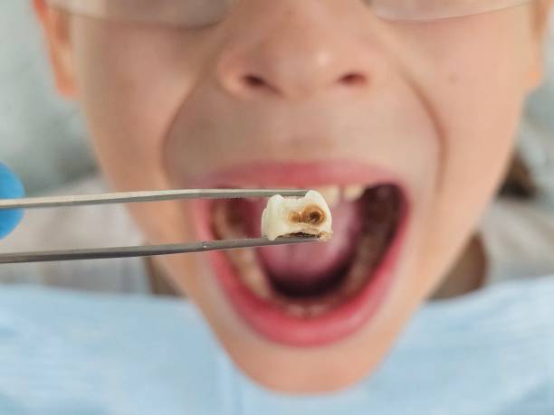 Best Emergency Dental Care for Broken or Chipped Teeth in Altoona, WI